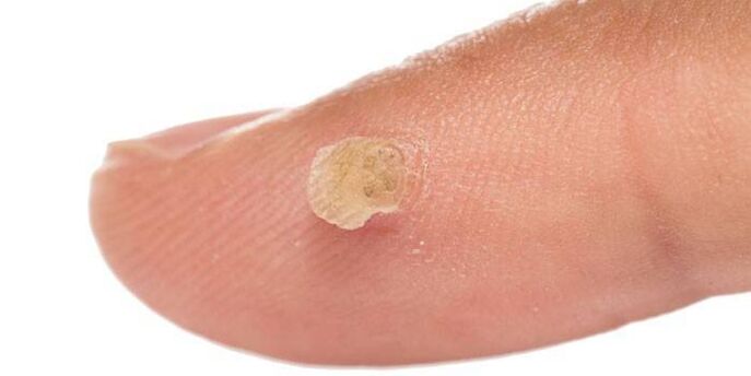 how to treat warts on fingers
