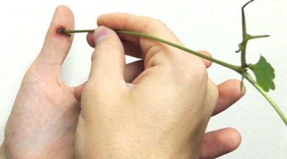 Cauterization of papillomas on fingers with celandine juice