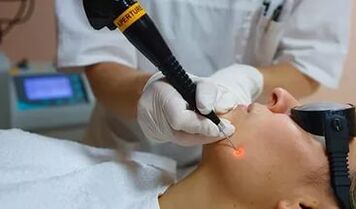Effective procedure to remove facial papilloma with laser