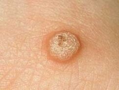 warts on the skin