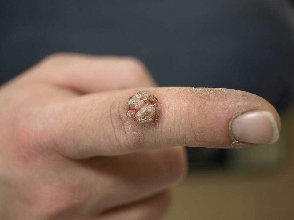 Large warts on fingers need removal