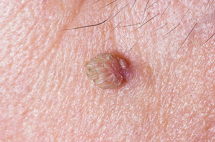 Skin warts can be removed in many ways
