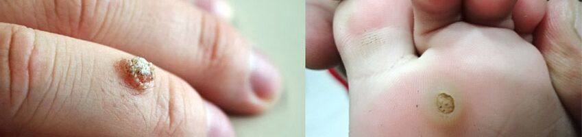 Warts on the fingers and warts on the soles of the feet