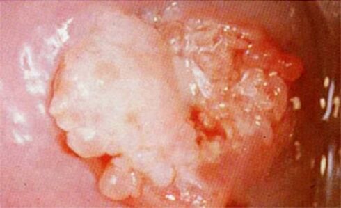 Cervical candidia