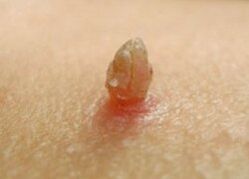 Papilloma sharp