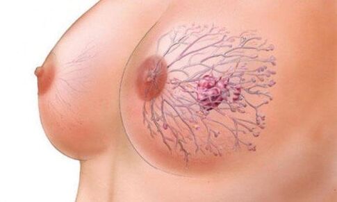 papillary
