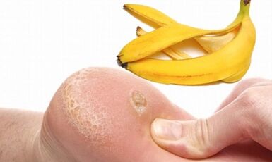 Banana peel to treat Plantar warts