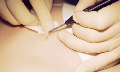 Plantar wart removal surgery