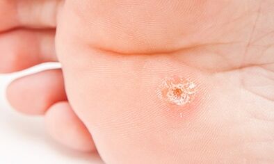 Why does plant warts appear