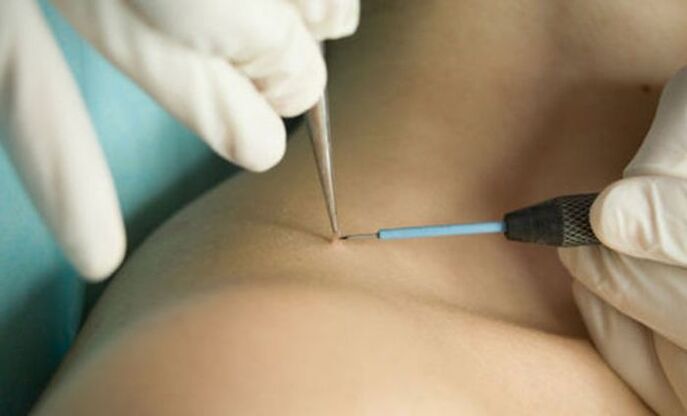 Use radio wave therapy