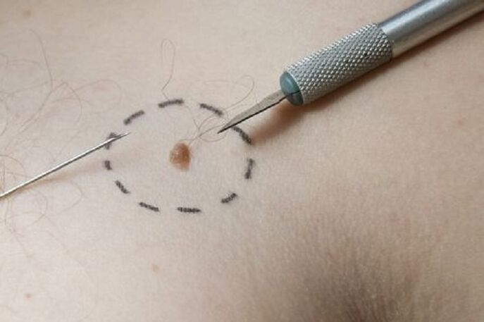Wart removal method