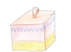 how to get rid of papillomas on the body