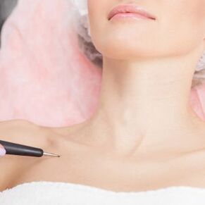 Laser papilloma removal