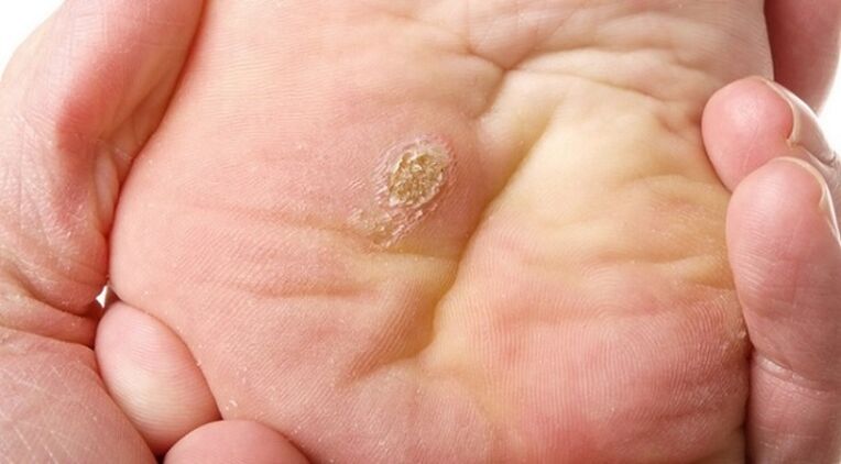 Plantar papilloma and flat