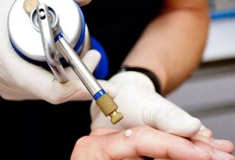 papilloma treatment methods