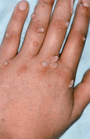 papilloma on hand
