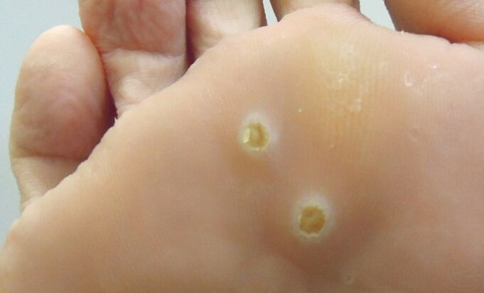 papillomas on the feet