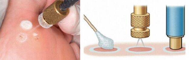 Cryodestructive method as a method to remove papillomas
