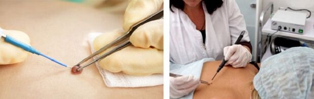 Electrocautery as a way to remove papillomas