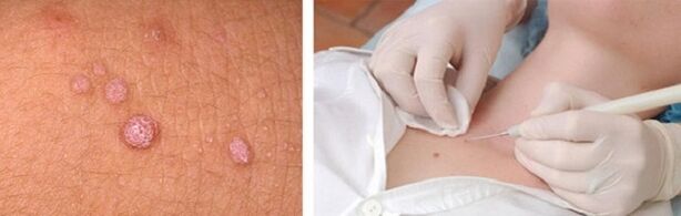 Professional body papilloma removal