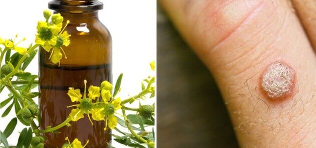 Treat warts with celandine medicine