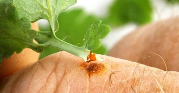 Treat warts with celandine