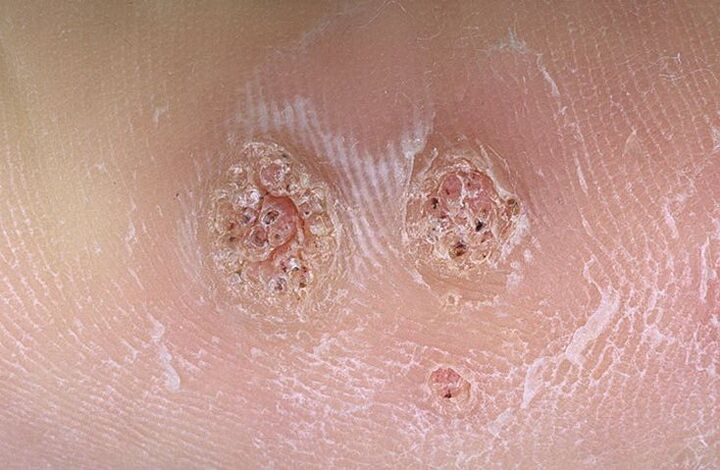 warts on the body