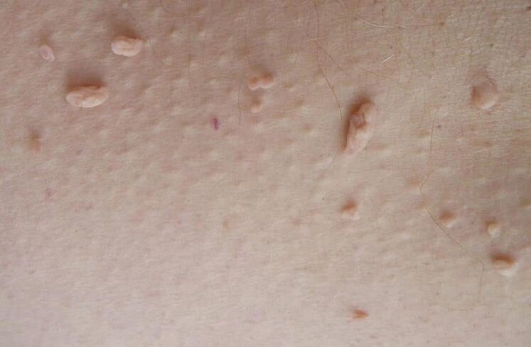 Fibrous papillomas on the skin