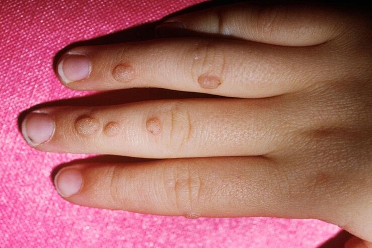 Vulgar warts on fingers
