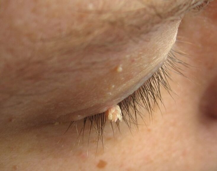 warts on eyelids