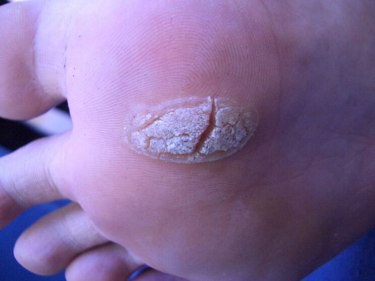 warts on the skin of the feet