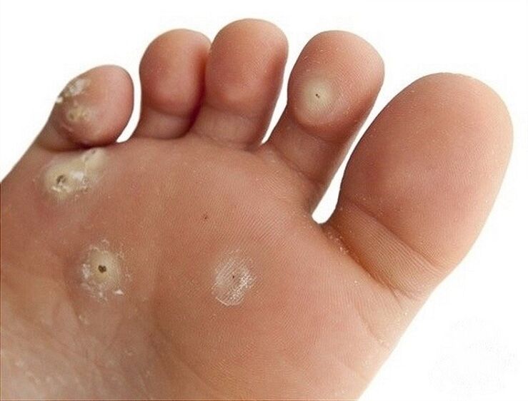 warts on the soles of the feet