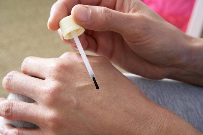 Burn warts with celandine juice