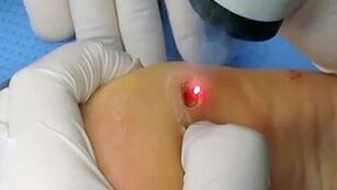 Removing Plantar warts with a laser