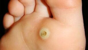 Warts under the soles of the feet