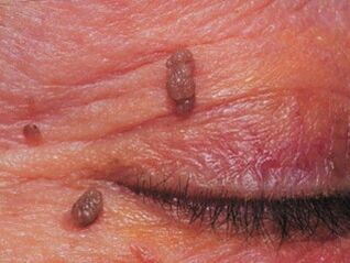 Papillomas on the eyelids