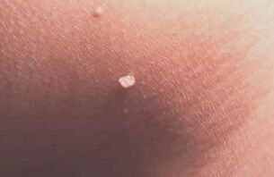 Papillomas on the skin