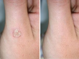 Warts before and after their removal