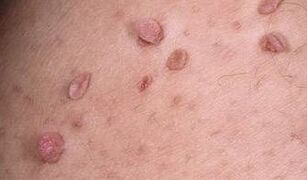 The reason for the appearance of papillomas on the body
